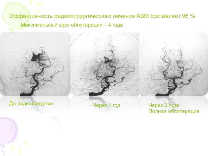 Эффективность радиохирургического лечения АВМ составляет 96 % Через 1 год До
