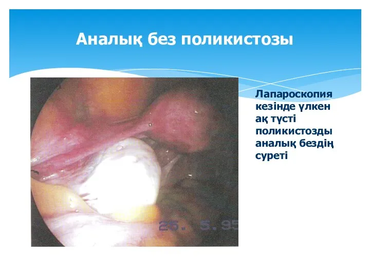 Аналық без поликистозы Лапароскопия кезінде үлкен ақ түсті поликистозды аналық бездің суреті