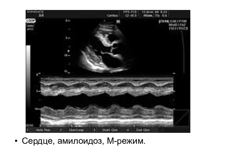 Сердце, амилоидоз, М-режим.