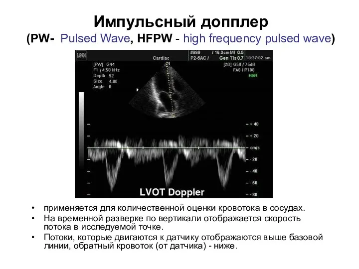 Импульсный допплер (PW- Pulsed Wave, HFPW - high frequency pulsed wave)