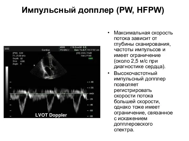 Импульсный допплер (PW, HFPW) Максимальная скорость потока зависит от глубины сканирования,