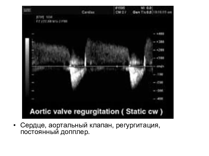 Сердце, аортальный клапан, регургитация, постоянный допплер.