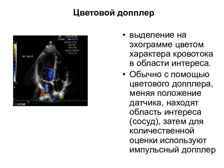 Цветовой допплер выделение на эхограмме цветом характера кровотока в области интереса.