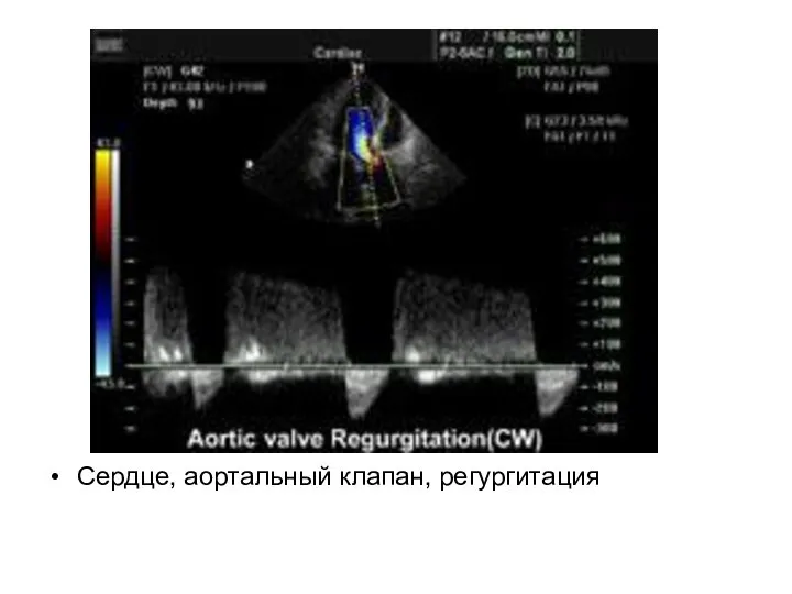 Сердце, аортальный клапан, регургитация