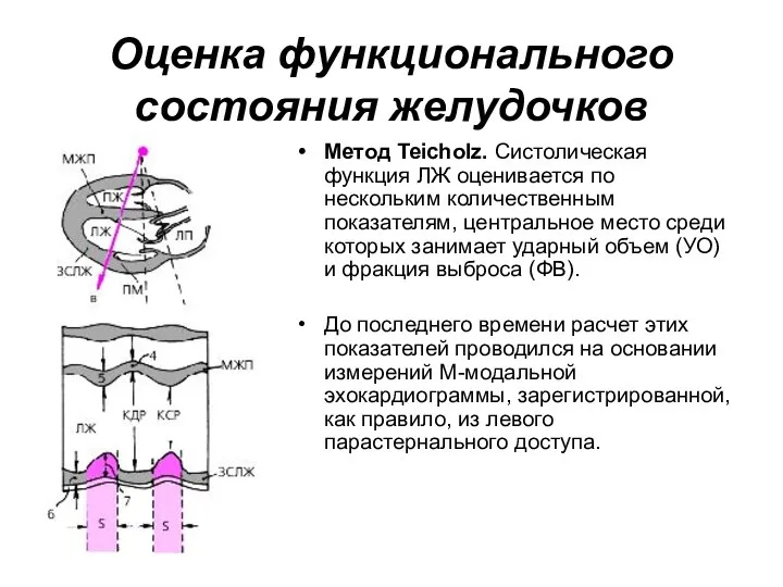 Оценка функционального состояния желудочков Метод Teicholz. Систолическая функция ЛЖ оценивается по