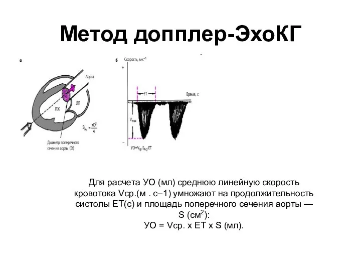 Метод допплер-ЭхоКГ Для расчета УО (мл) среднюю линейную скорость кровотока Vср.(м