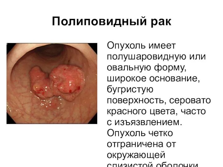 Полиповидный рак Опухоль имеет полушаровидную или овальную форму, широкое основание, бугристую