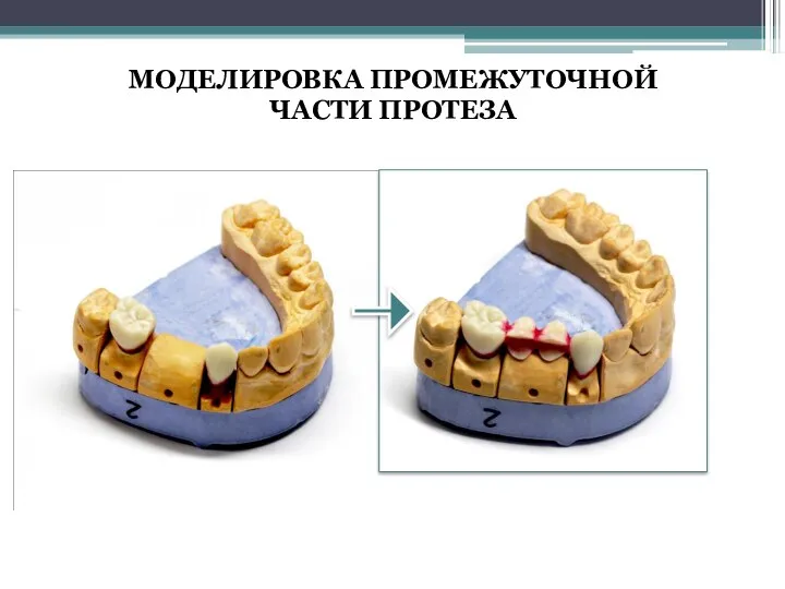 МОДЕЛИРОВКА ПРОМЕЖУТОЧНОЙ ЧАСТИ ПРОТЕЗА