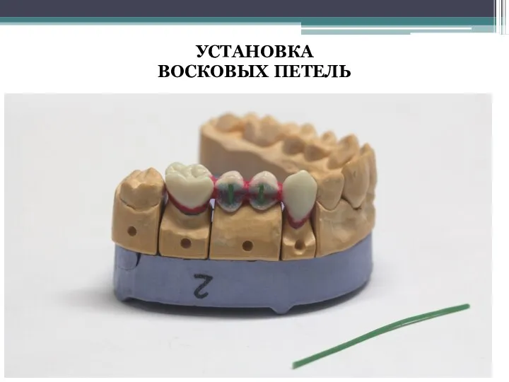 УСТАНОВКА ВОСКОВЫХ ПЕТЕЛЬ