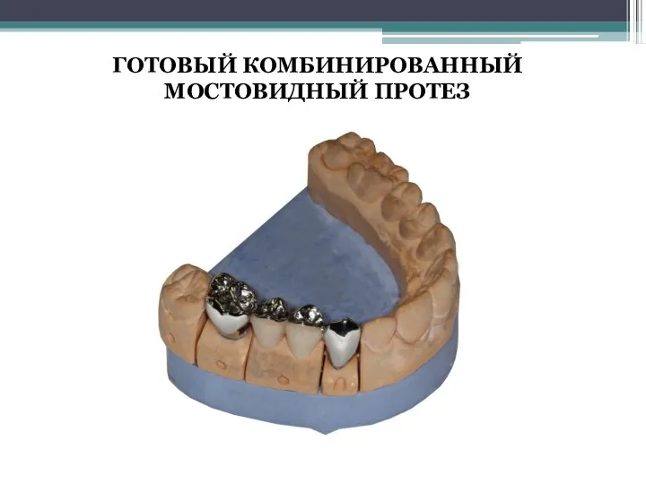 ГОТОВЫЙ КОМБИНИРОВАННЫЙ МОСТОВИДНЫЙ ПРОТЕЗ