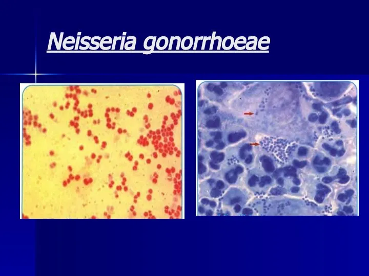 Neisseria gonorrhoeae