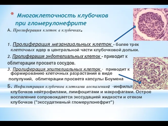 Многоклеточность клубочков при гломерулонефрите А. Пролиферация клеток в клубочках. 1. Пролиферация