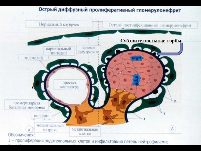 Субэпителиальные горбы