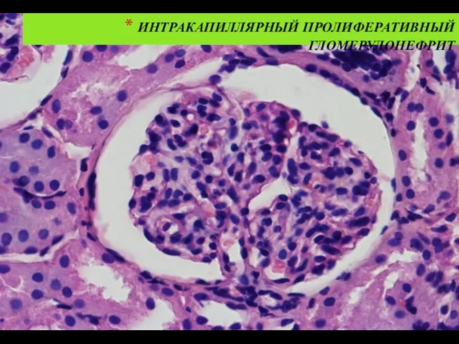 ИНТРАКАПИЛЛЯРНЫЙ ПРОЛИФЕРАТИВНЫЙ ГЛОМЕРУЛОНЕФРИТ