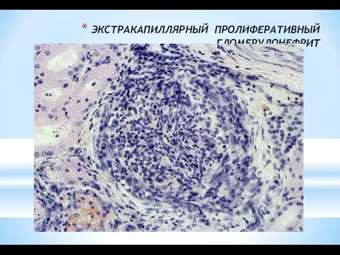 ЭКСТРАКАПИЛЛЯРНЫЙ ПРОЛИФЕРАТИВНЫЙ ГЛОМЕРУЛОНЕФРИТ