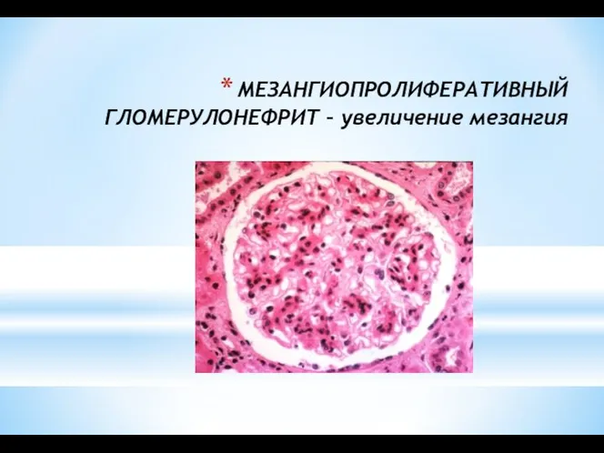 МЕЗАНГИОПРОЛИФЕРАТИВНЫЙ ГЛОМЕРУЛОНЕФРИТ – увеличение мезангия