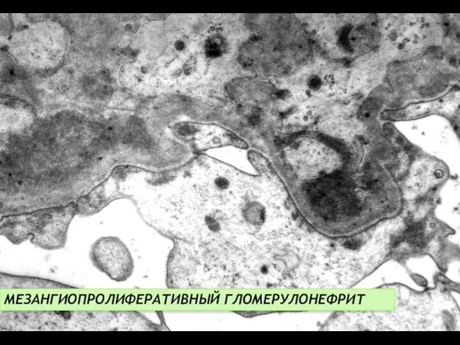 МЕЗАНГИОПРОЛИФЕРАТИВНЫЙ ГЛОМЕРУЛОНЕФРИТ