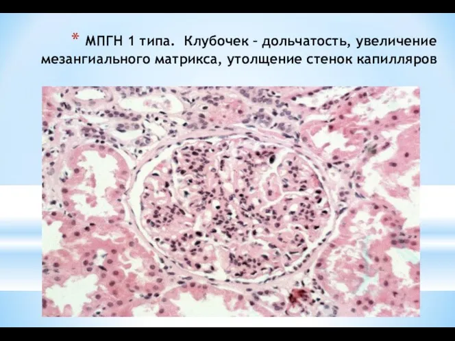 МПГН 1 типа. Клубочек – дольчатость, увеличение мезангиального матрикса, утолщение стенок капилляров