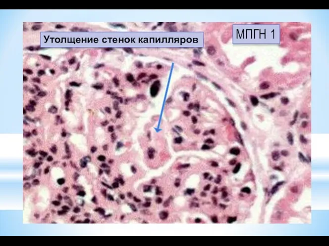 Утолщение стенок капилляров МПГН 1