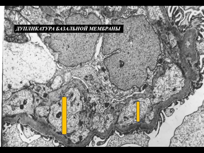 ДУПЛИКАТУРА БАЗАЛЬНОЙ МЕМБРАНЫ