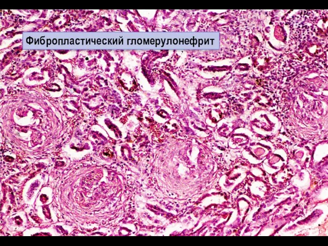 Фибропластический гломерулонефрит
