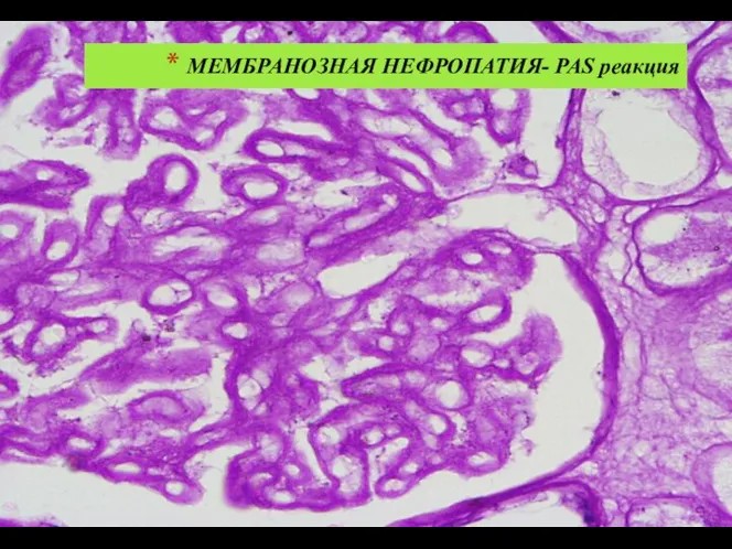 МЕМБРАНОЗНАЯ НЕФРОПАТИЯ- PAS реакция