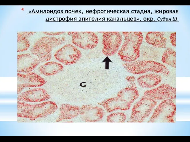 «Амилоидоз почек, нефротическая стадия, жировая дистрофия эпителия канальцев», окр. Судан Ш.