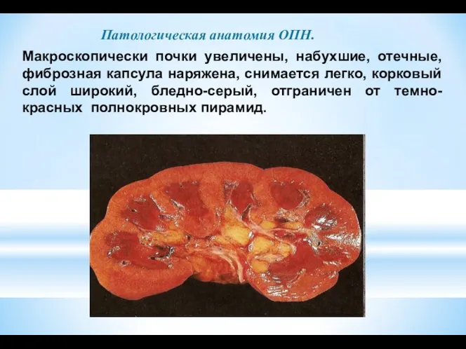 Патологическая анатомия ОПН. Макроскопически почки увеличены, набухшие, отечные, фиброзная капсула наряжена,