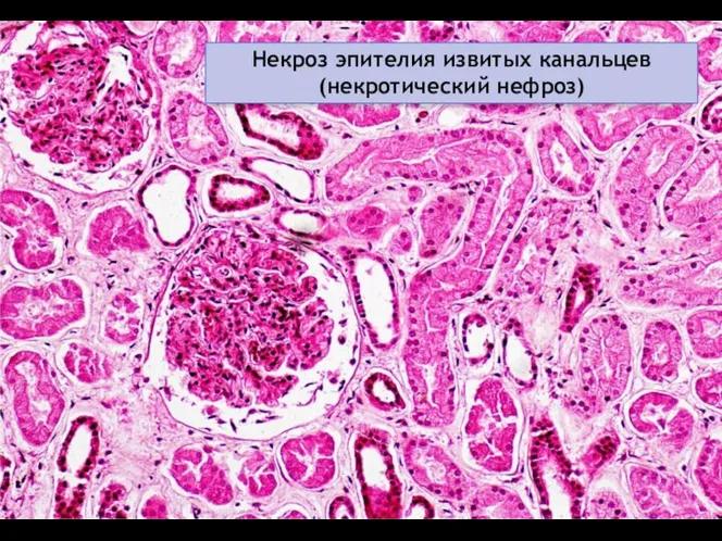 Некроз эпителия извитых канальцев (некротический нефроз)