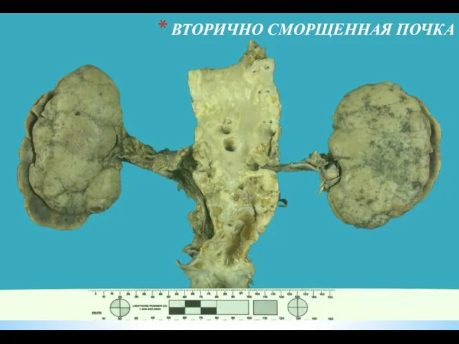 ВТОРИЧНО СМОРЩЕННАЯ ПОЧКА