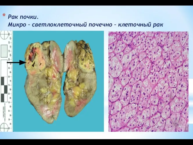 Рак почки. Микро – светлоклеточный почечно – клеточный рак