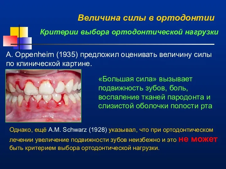 Величина силы в ортодонтии Критерии выбора ортодонтической нагрузки A. Oppenheim (1935)