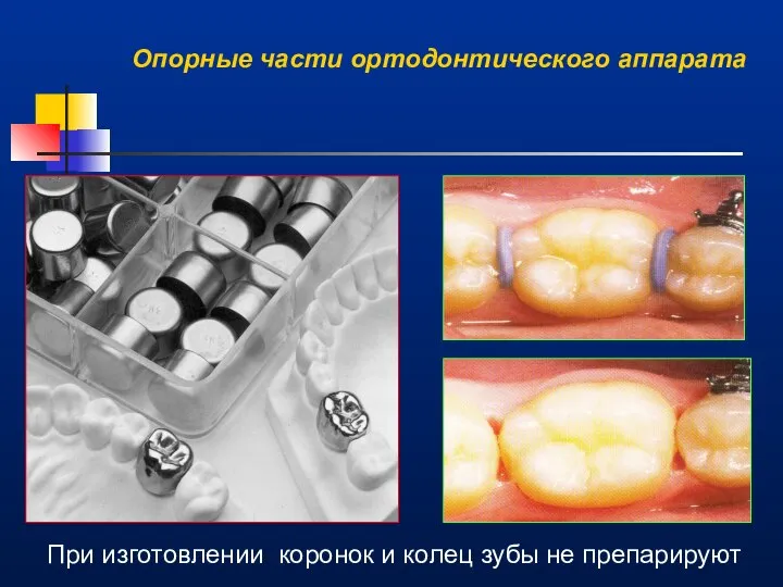 При изготовлении коронок и колец зубы не препарируют Опорные части ортодонтического аппарата