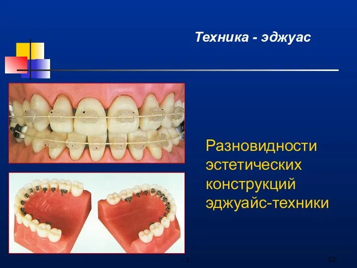 1 Техника - эджуас Разновидности эстетических конструкций эджуайс-техники