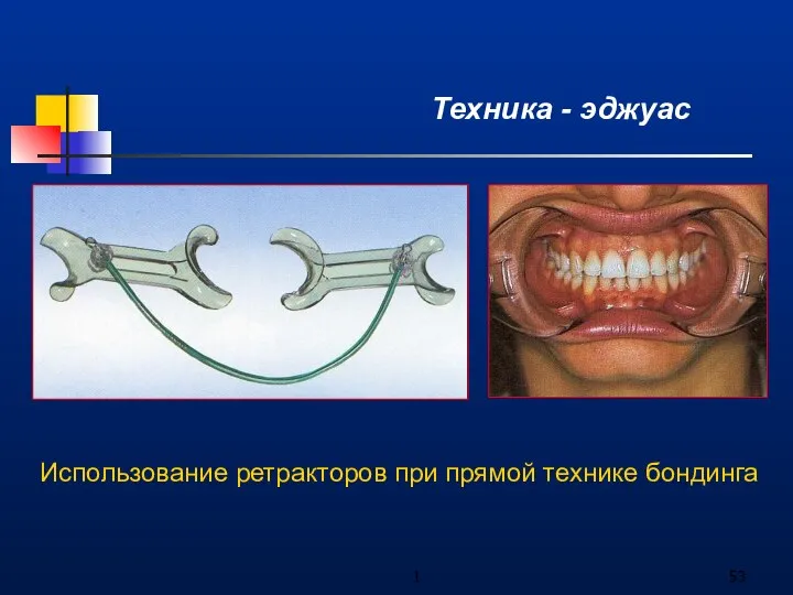 1 Техника - эджуас Использование ретракторов при прямой технике бондинга