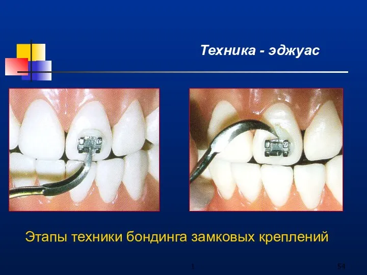 1 Техника - эджуас Этапы техники бондинга замковых креплений