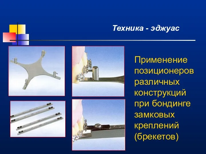 Техника - эджуас Применение позиционеров различных конструкций при бондинге замковых креплений (брекетов)