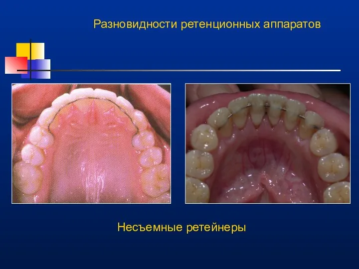 Разновидности ретенционных аппаратов Несъемные ретейнеры