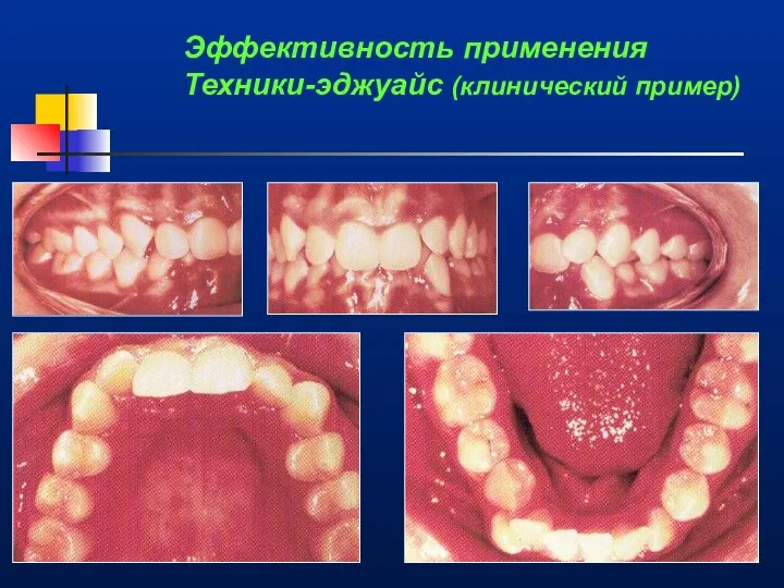 Эффективность применения Техники-эджуайс (клинический пример)