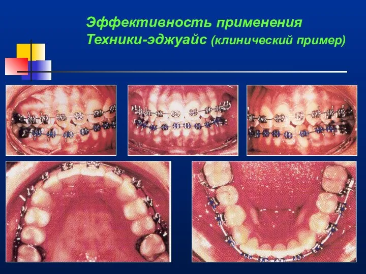 Эффективность применения Техники-эджуайс (клинический пример)