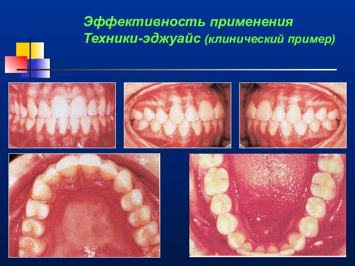 Эффективность применения Техники-эджуайс (клинический пример)