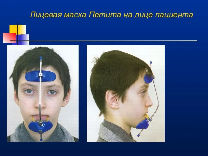 Лицевая маска Петита на лице пациента