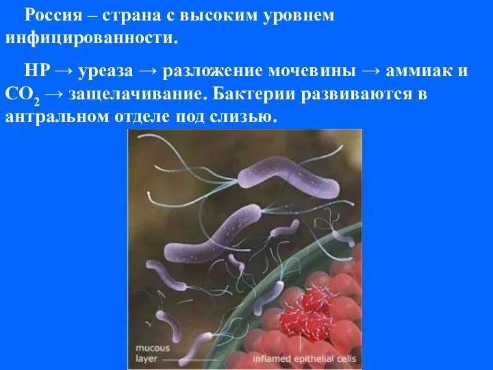 Россия – страна с высоким уровнем инфицированности. HP → уреаза →