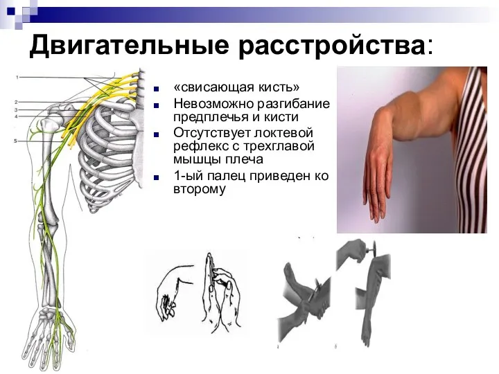 Двигательные расстройства: «свисающая кисть» Невозможно разгибание предплечья и кисти Отсутствует локтевой