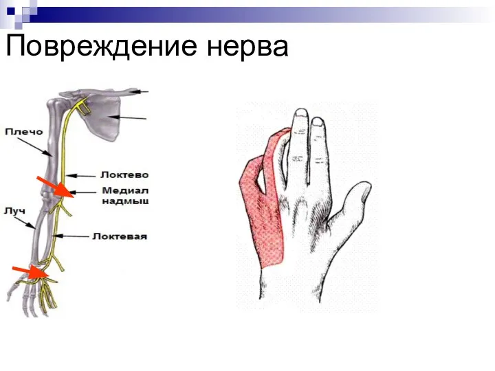 Повреждение нерва