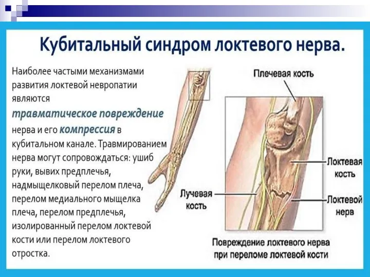 Кубитальный синдром: