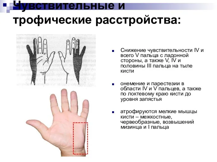 Чувствительные и трофические расстройства: Снижение чувствительности IV и всего V пальца