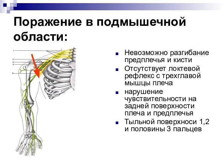 Поражение в подмышечной области: Невозможно разгибание предплечья и кисти Отсутствует локтевой