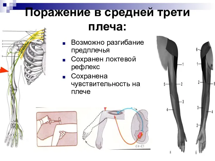 Поражение в средней трети плеча: Возможно разгибание предплечья Сохранен локтевой рефлекс Сохранена чувствительность на плече