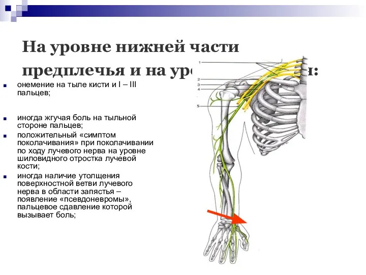 На уровне нижней части предплечья и на уровне запястья: онемение на